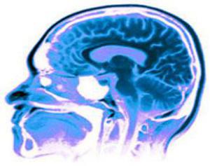 Плохая связь между отделами мозга вызывает анорексию