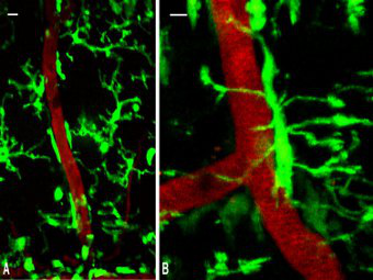 Ученые увидели начало поражения нервов при рассеянном склерозе