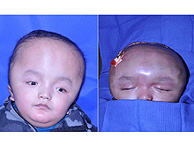 В ходе необычной операции хирурги удалили ребенку половину черепной коробки