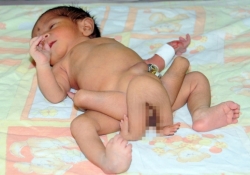 6 ног – не приговор: врачи борются за жизнь необычного младенца