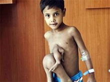 Докторы устранили редкую аномалию, избавив четырехрукого ребенка от лишних конечностей