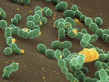 Кариес и инсульт вызывает одна и та же бактерия