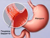 Обнаружены генетические детерминанты развития пищевода Барретта