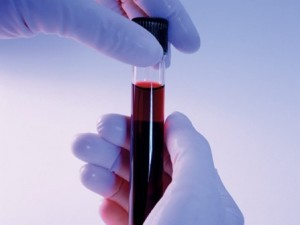 Новой анализ крови спасет от тромбоза
