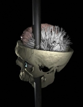 Восстановлены детали самой знаменитой черепно-мозговой травмы в истории медицины