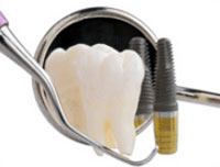 Классическая или имплантация зубов БОИ?