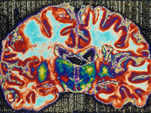 Размер мозжечка и риск развития шизофрении связаны