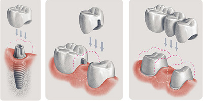 Стратегия замещения утрачиваемых зубов