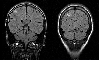 Магнитно-резонансная томография головы и головного мозга