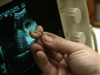 Минздрав сократил перечень показаний для проведения бесплатных абортов