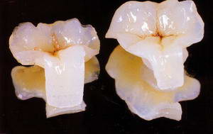 Циркониевые коронки для зубов снижают вероятность кариеса 