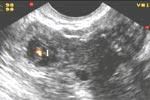 Сыворотка определяет внематочную беременность