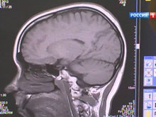 В мозге человека содержится спасение от тяжеленной эпилепсии, установили неврологи