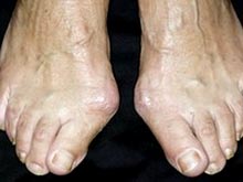 Генетика определяет вероятность появления деформаций пальцев ног