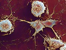 Рассеянный склероз и редкая генетическая аномалия связаны
