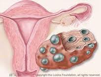 Дамы с синдромом поликистозных яичников подвергаются высокому риску развития тромбозов