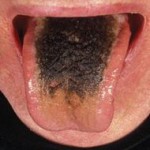 Курение приводит к заболеваниям полости рта