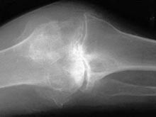 Неожиданное открытие: костная ткань - истинная причина развития артрита