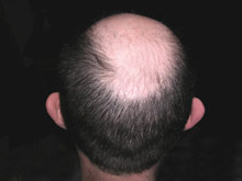Мужчины, потерявшие волосы в среднем возрасте, рискуют пострадать от рака
