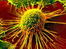 Сенсация: антиоксиданты помогают раковым опухолям