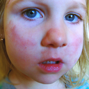 Фаст-фуд делает из детей аллергиков