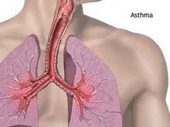 3-я фаза клинических испытаний подтвердила эффективность нового лекарства от астмы