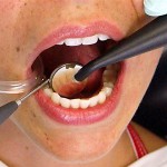 Ревматизм и лечение зубов