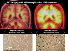 Молекулярная визуализация - прорыв в диагностике слабоумия