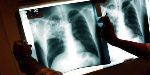 Ученые предложили определять туберкулез по дыханию бактерий