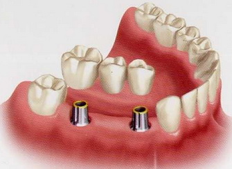 Имплантиция и протезирование зубов - СитиСмайл