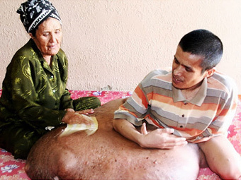 Вьетнамцу удалили 90-килограммовую опухоль