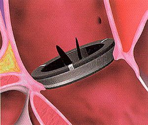 В Югре выполнена одна из сложных кардиохирургических операций на клапанах сердца 