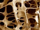 Длительное применение препарата деносумаба для лечения остеопороза