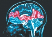 Изучена роль стресса в появлении эпилептических припадков