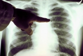 Дыхательный тест поможет выявить злокачественность рака легкого