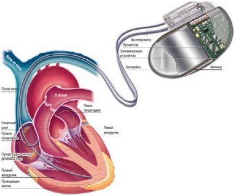 Пациенты с низким весом хуже переносят имплантацию дефибриллятора