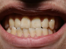 Зубы вернут свободу пациентам с переломами позвоночника