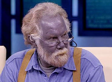 Из-за неправильного лечения дерматита американец получил фиолетовую окраску