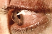 Ученые нашли генетические причины кератоконуса и глаукомы
