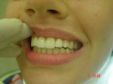 Восстановление частично или полностью утраченных зубов