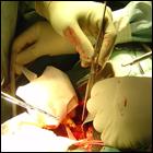В Рф ежегодно проводится только 10 проц необходимых операций по трансплантации органов - главный трансплантолог