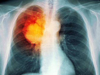 Геномный анализ объяснил предрасположенность некурящих азиаток к раку легких