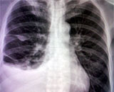 Ученые исследовали методы лечения проблем с дыханием