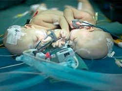 Китайские врачи успешно разделили сиамских близнецов