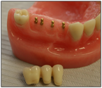 Стоит ли ставить зубные имплантаты? 