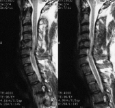 Боль при травмах спинного мозга на срок до 8 месяцев может убрать одна инъекция!