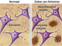 Исследование: болезнь Альцгеймера может быть заразной