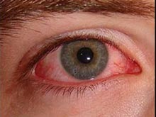 Заражение гриппом может вылиться в болезни глаз