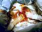 В ведущем кардиологическом диспансере Югры успешно прошла имплантация стент-графта 
