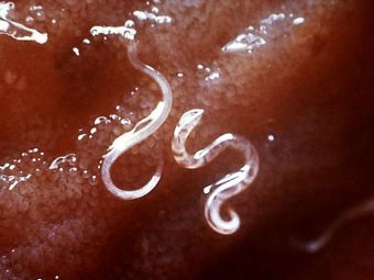 Заражение паразитическими червями облегчило симптомы аллергии у британца